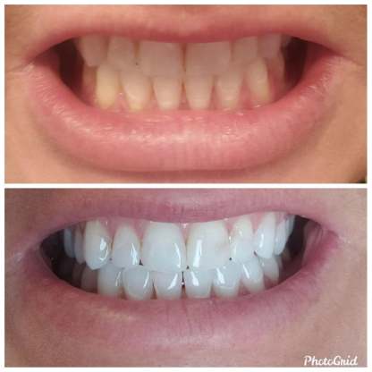 Transparent White Teeth High Strength Whitening Gel Pen-xinru