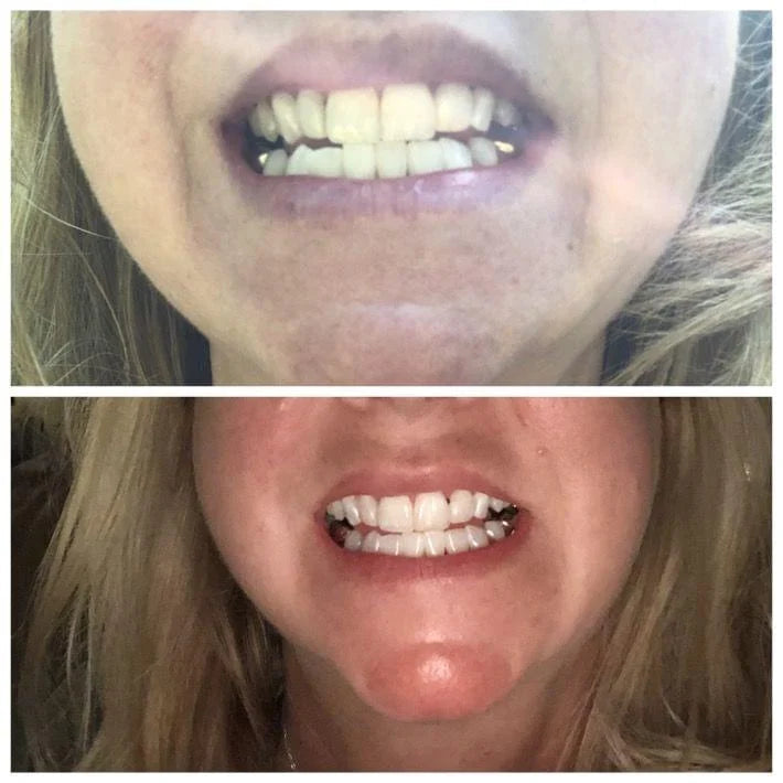 Transparent White Teeth High Strength Whitening Gel Pen-xinru