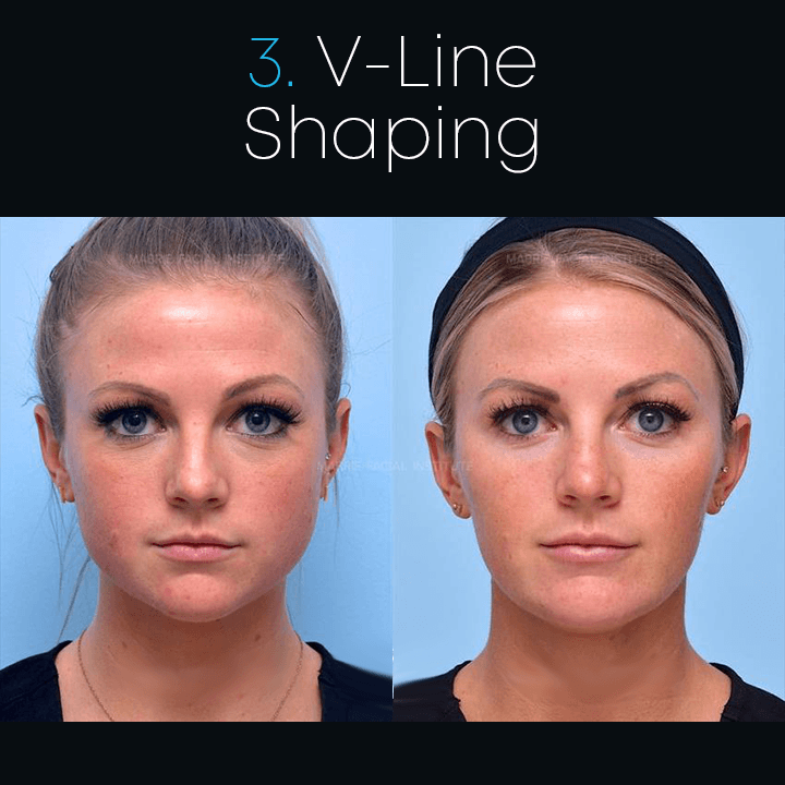 Anti-aging Anti-wrinkle Tape Ultrasonic Face Slimming Ring-xinru