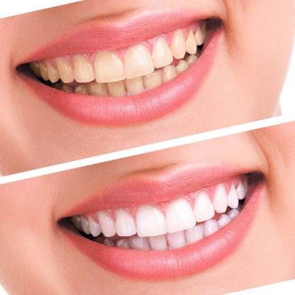 Dental Teeth Bleaching Whitening System-xinru