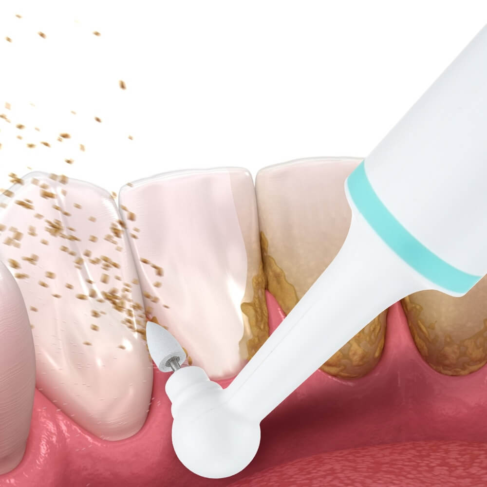 How To Remove Plaque From Retainers