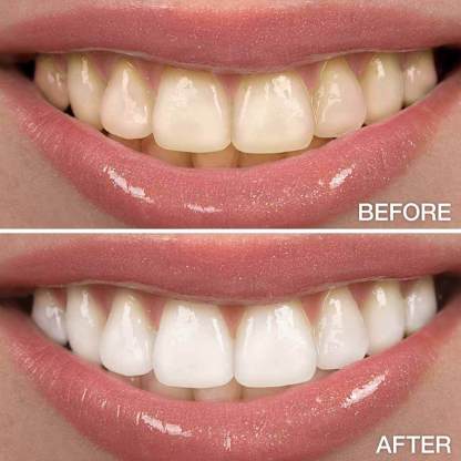 Transparent White Teeth High Strength Whitening Gel Pen-xinru