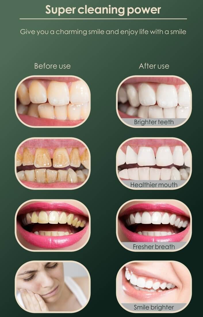 Calculus Removal Before And After