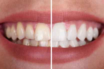 Transparent White Teeth High Strength Whitening Gel Pen-xinru