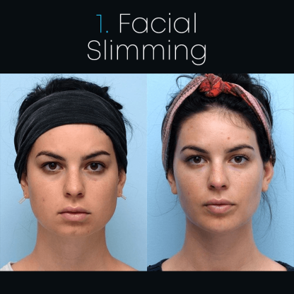 Anti-aging Anti-wrinkle Tape Ultrasonic Face Slimming Ring-xinru