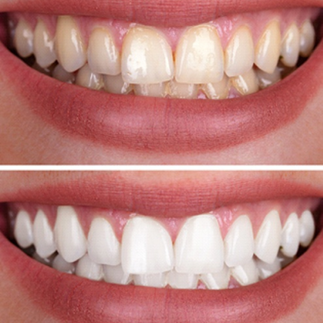 Professional Teeth Whitening Strips Bleaching Gel Dental Care Kit-xinru