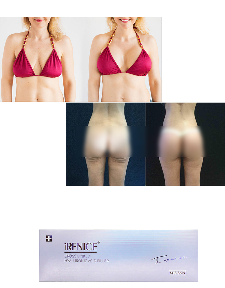 Oem Bulk iRenice Injectable Liquid Hyaluronic Acid Facial Dermal Filler for Face Breast Lip Buttock Hip Lift-iRENICE