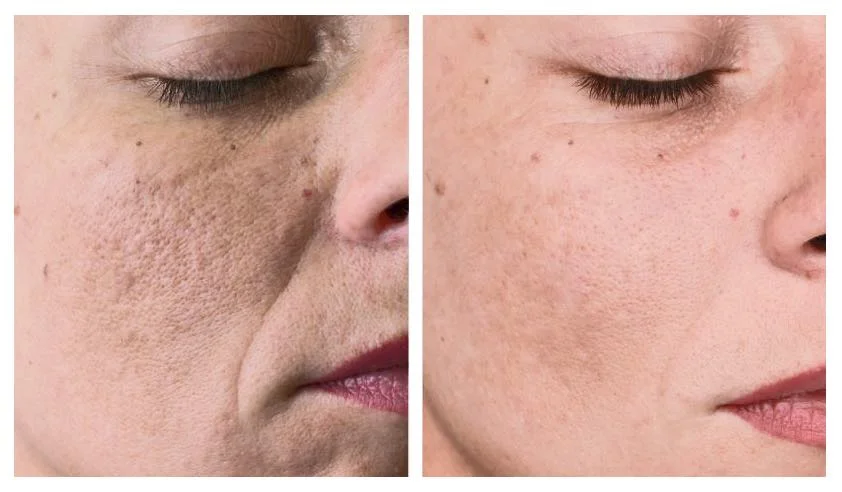 Mesotherapy Non Cross-Linked Sodium Hyaluronate Gel Dermal Filler Injection Beauty Salon Use Derma Pen Injection