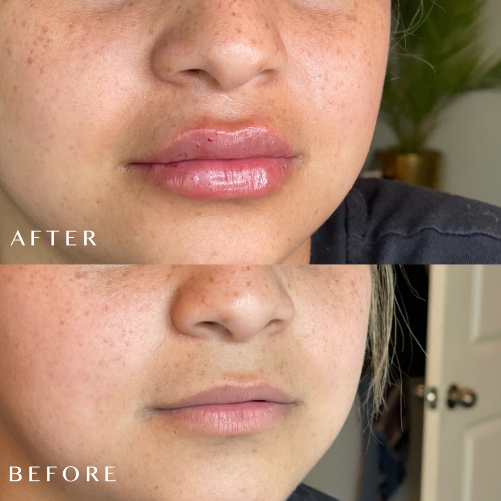 iRenice Acid Hyaluronic Anti Aging Treatments Dermal Deep Filler Injection Nose lift Ha Fillers-iRENICE