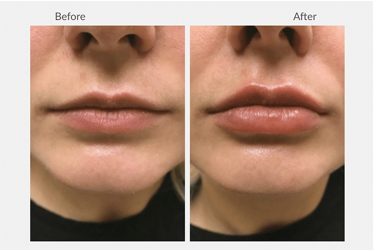 Injectable Cross-Linked Sodium Hyaluronate Gel Plump up Lips Dermal Filler