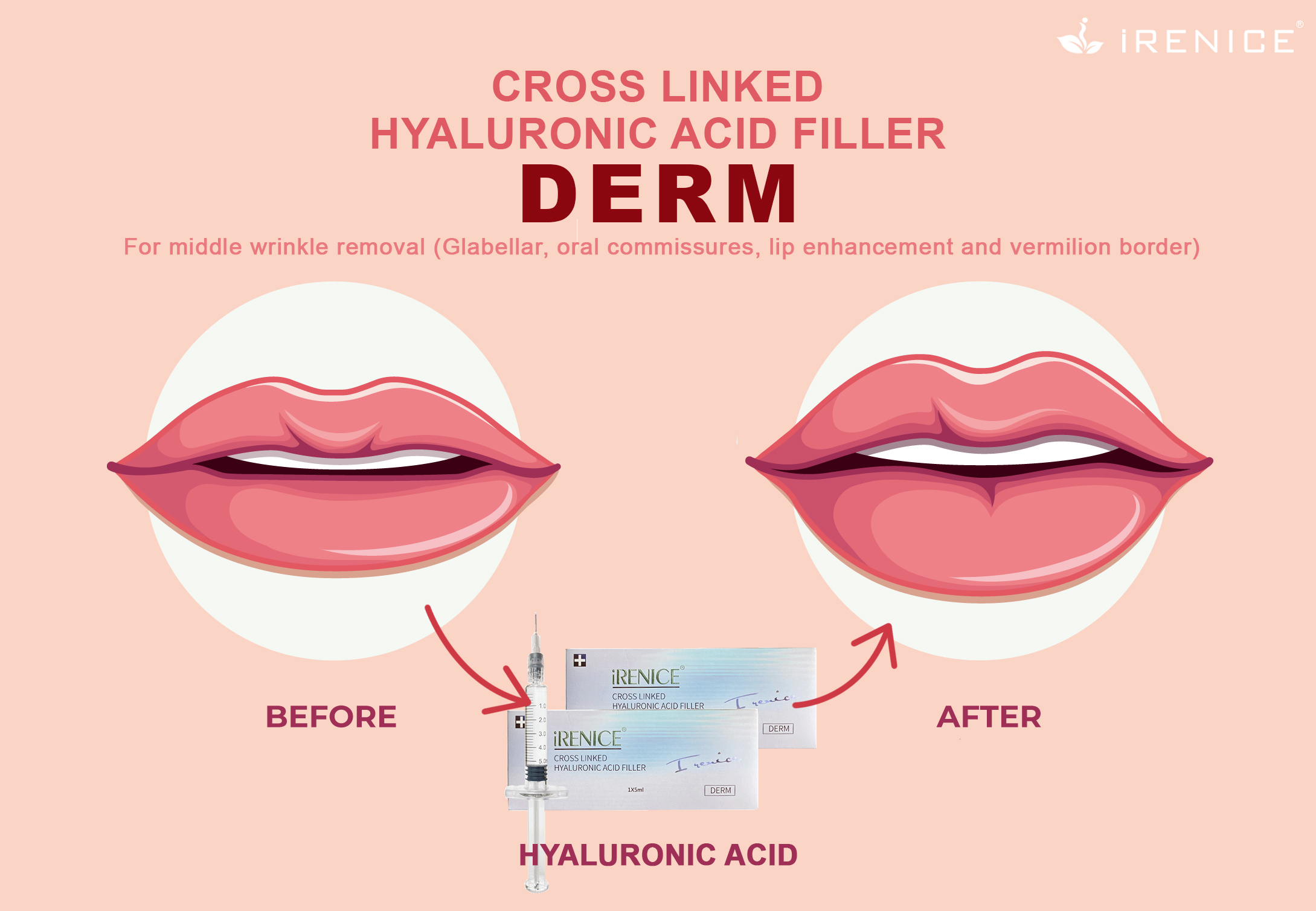 Fake injectable dermal fillers: A dangerous trend in the beauty industry -iRENICE