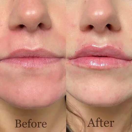 Injectable Cross-Linked Sodium Hyaluronate Gel Plump up Lips Dermal Filler