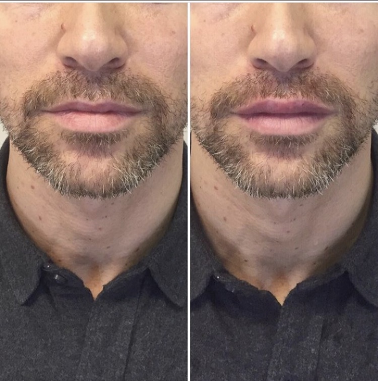 Injectable Cross Linked Hyaluronic Acid sodium hyaluronate Gel Lip Augmentation Dermal Filler for hyaluron pen injector-iRENICE