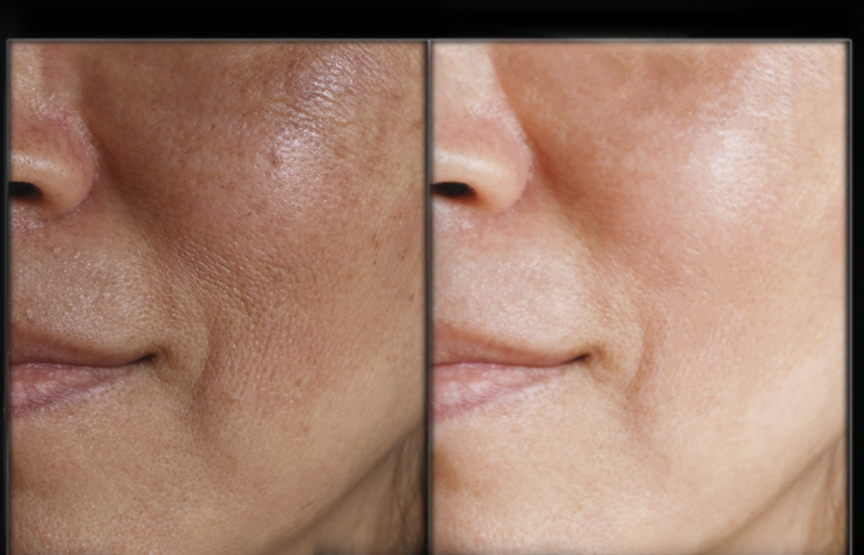 MesoGLO Facial - Style Aesthetics by RajaniMD