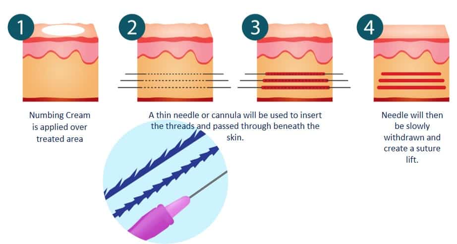 What You Should & Should not Do after Thread Lift in Singapore