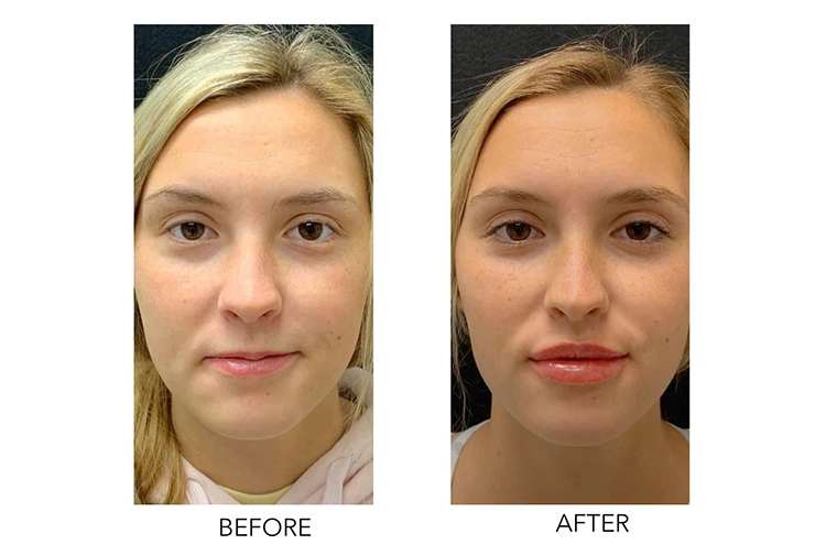 Injectable Cross-Linked Sodium Hyaluronate Gel Plump up Lips Dermal Filler