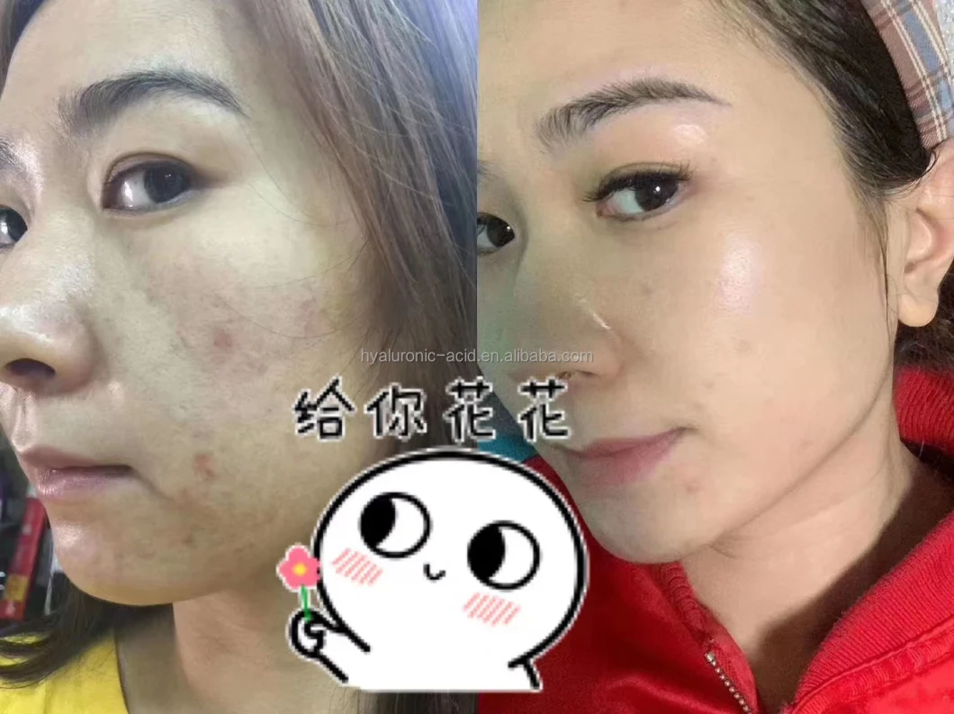 Anti Ageing Brightening Skin Lightening Anti Aging Whitening Skin Hyaluronic Acid Serum Mesotherapy