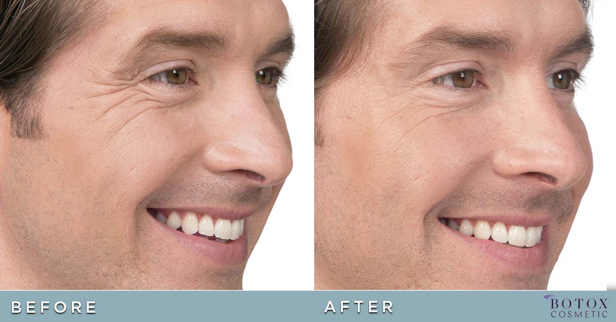 BOTOX Washington D.C. | Best Botox Injections DC
