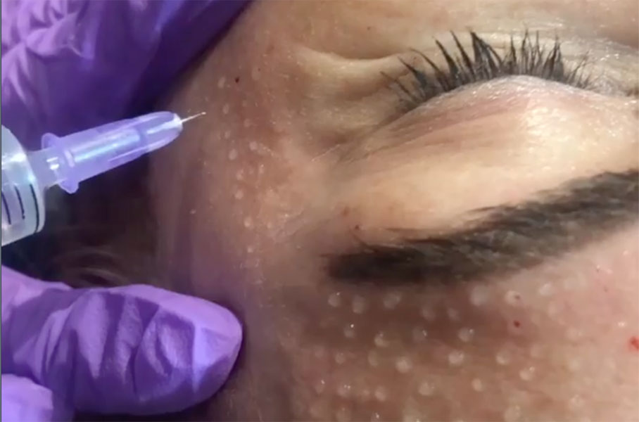 Mesotherapy Nappage – all you need to know | Charlotte Rye