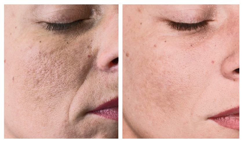 Mesotherapy – Natural Vegan Solution For Skin Glow-iRENICE