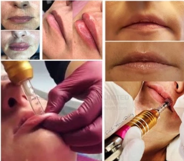 0.3ml and 0.5ml Hyaluron Pen Ampoules Syringe Adjustable Ampoule Head For High Pressure Hyaluronic Acid Pen-iRENICE