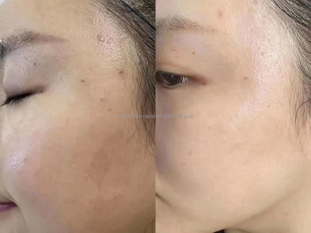 Anti Ageing Brightening Skin Lightening Anti Aging Whitening Skin Hyaluronic Acid Serum Mesotherapy