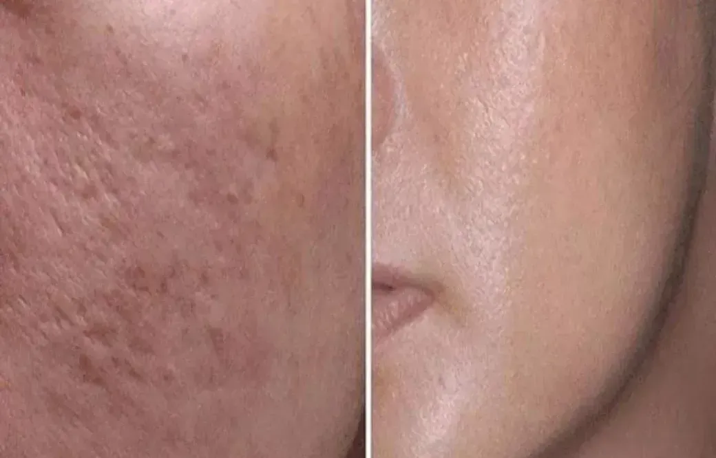 Aparat masaj facial Hydra Roller aplicator pentru serum regenerarea pielii, mezoterapie si indepartare cicatrici, Derma Lifting, 0.25 mm - eMAG.ro