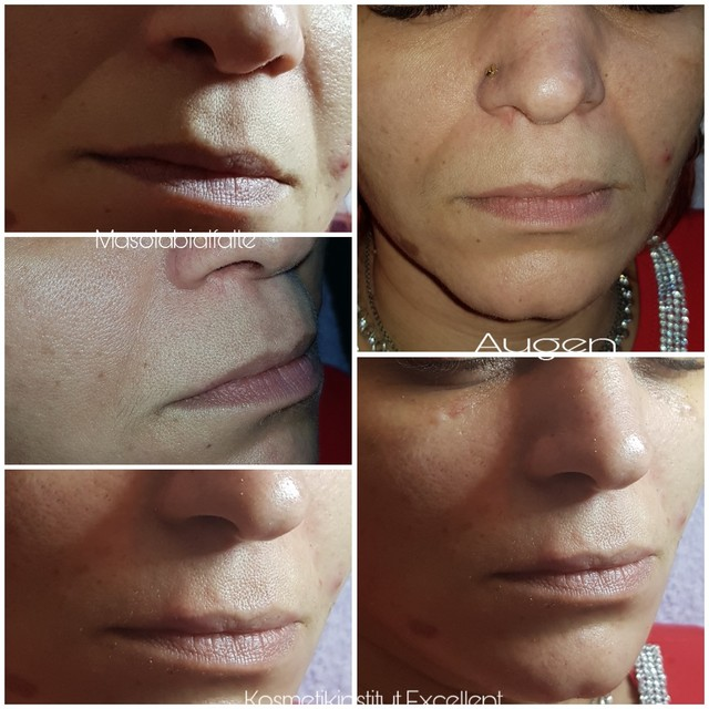 What types of dermal fillers are available?-iRENICE