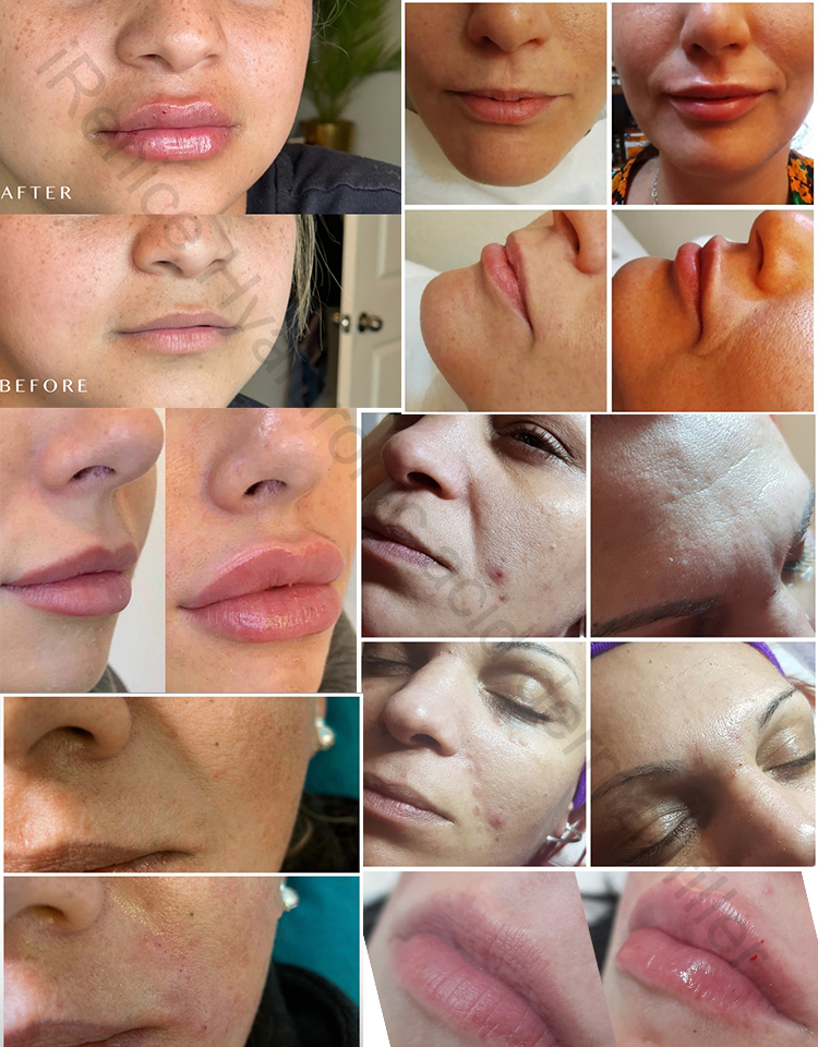 Learn iRenice dermal filler-iRENICE
