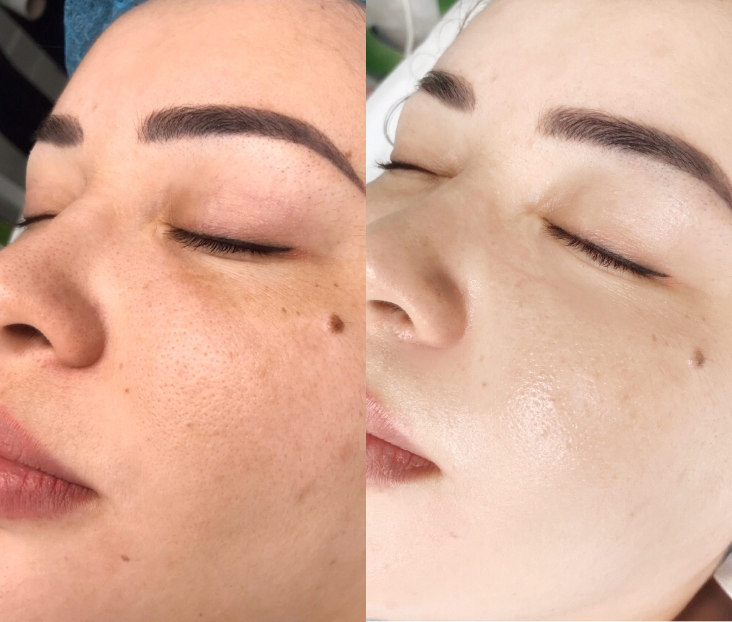 Vitamin b12 hyaluronic acid repair solution anti wrinkle anti-aging skin care moisturizing serum Face care 5ml-iRENICE