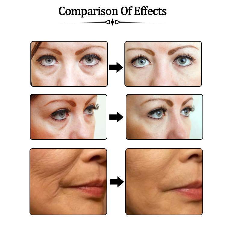 1ml2mlSexy Lip Ha Cross-linked Hyaluronic Acid Dermal Filler To Buy (medium 1ml/2ml) 