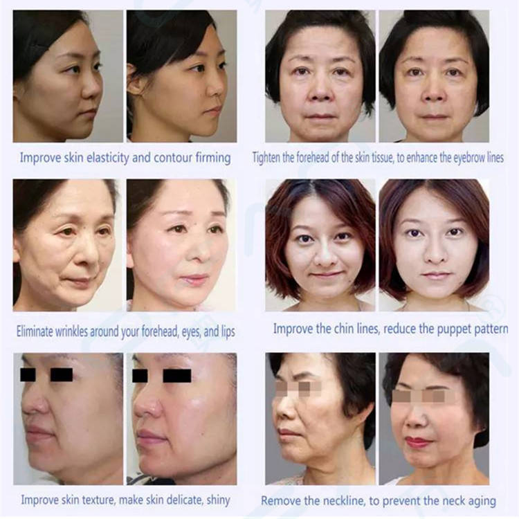 Mini Pro High Intensity Focused Ultrasound Hifu For Face Lift Body Slimming Wrinkle Removal