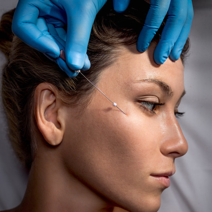 Non-Surgical Absorbable Pdo Face Lifting Thread For Skin Tightening And Lifting