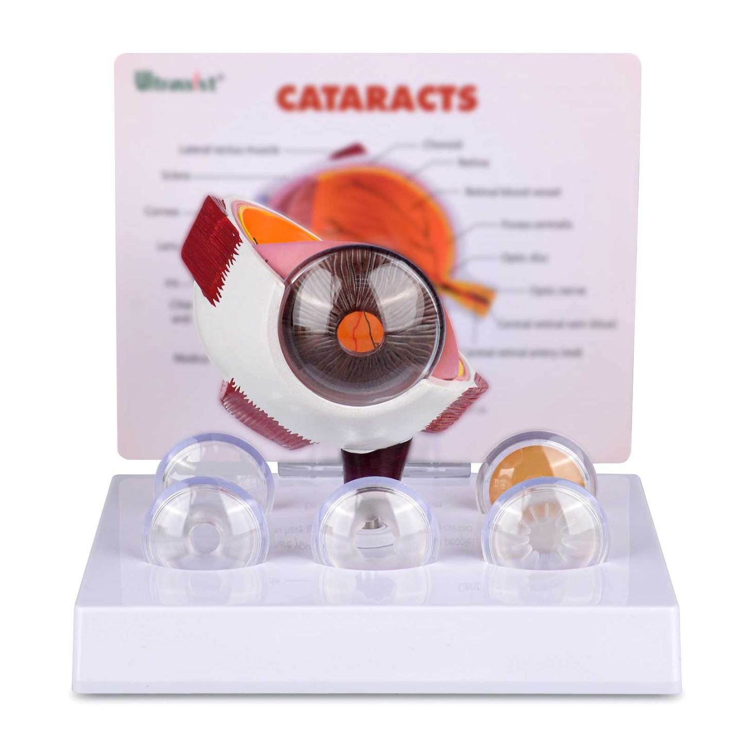 Human Cataract Eye Model for Medical Education