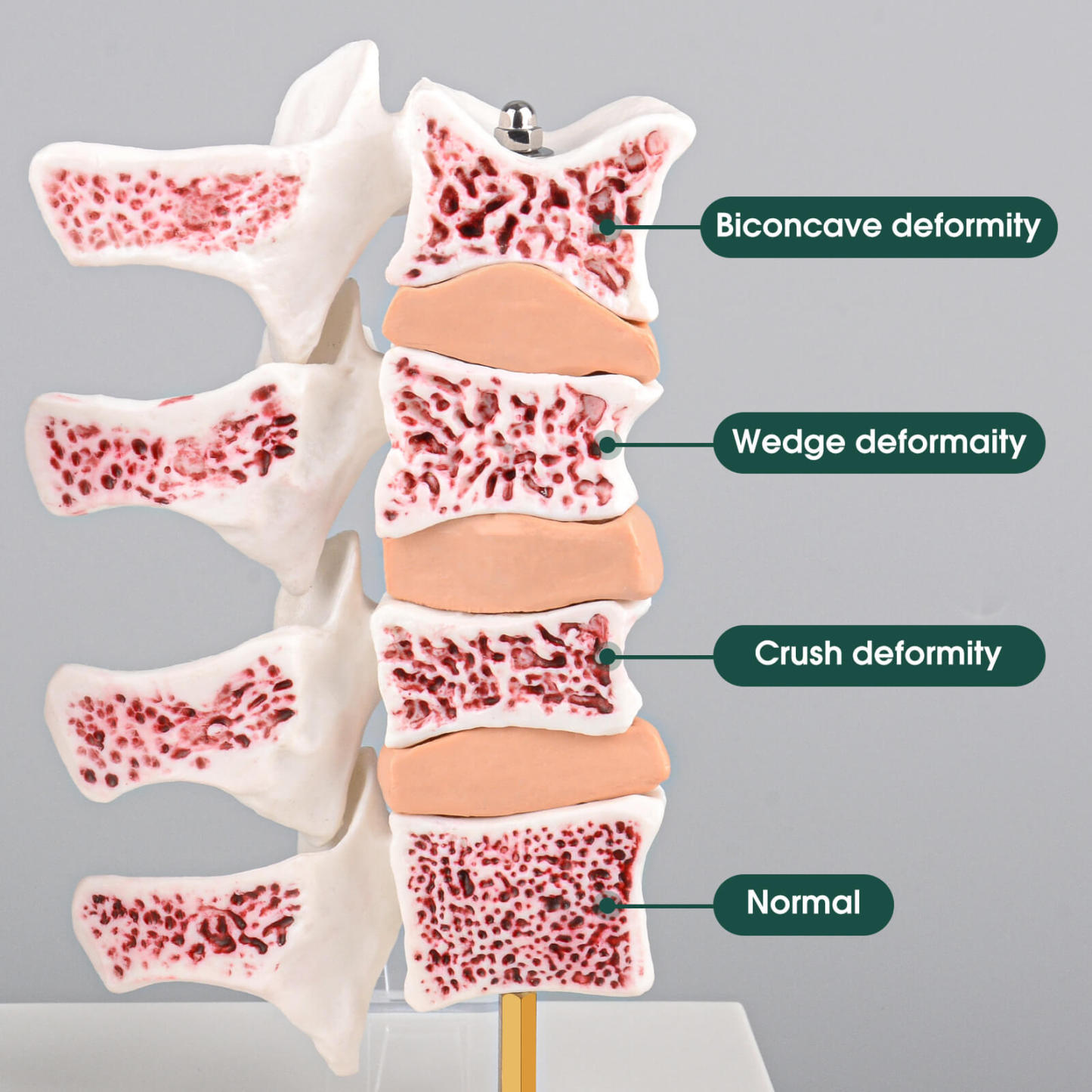 Ultrassist Osteoporosis Model with Common 4 Types of Osteoporosis Vertebrae