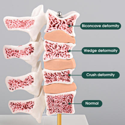 Ultrassist Osteoporosis Model with Common 4 Types of Osteoporosis Vertebrae