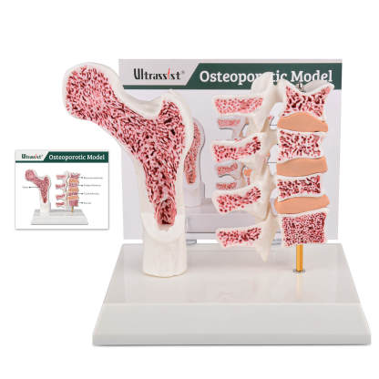 Ultrassist Osteoporosis Model for Teaching Demonstration with Study Card