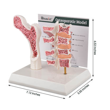 Ultrassist Pathological Osteoporosis Femur & Vertebrae Model Size