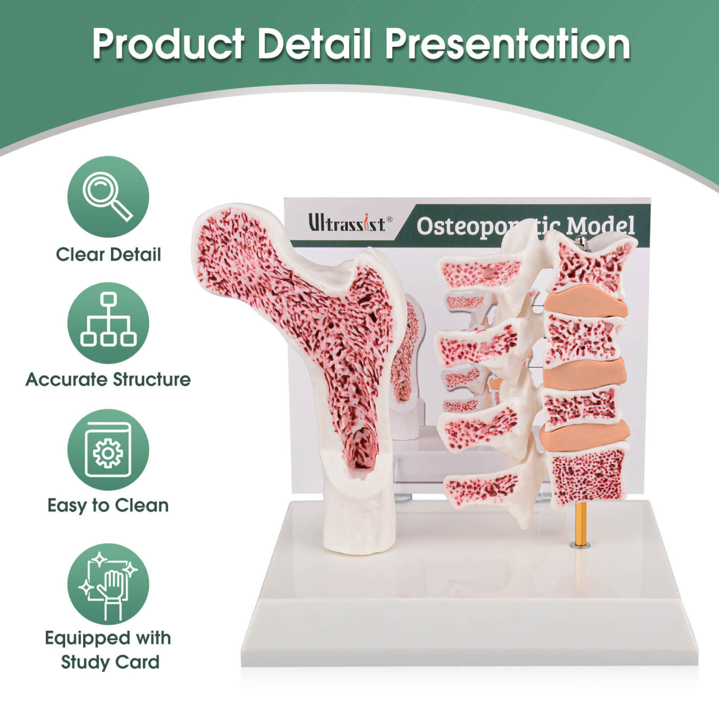 Ultrassist Osteoporosis Model with Clear Details for Teaching Demonstration