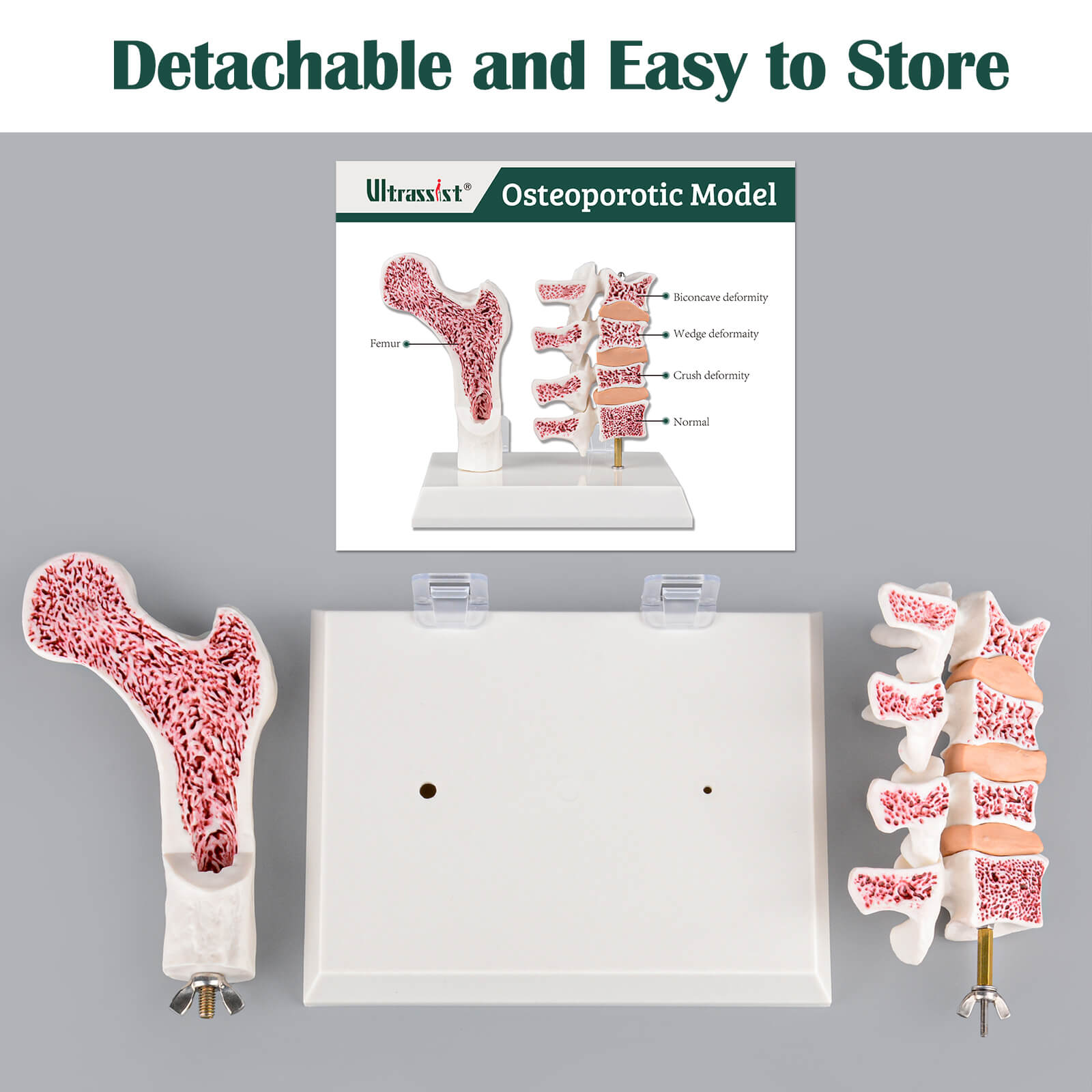 Detachable Osteoporosis Model for Easy Store and Transport