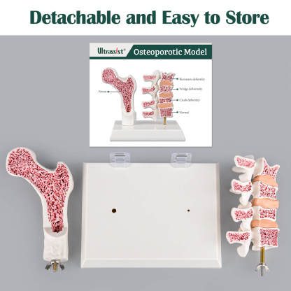 Detachable Osteoporosis Model for Easy Store and Transport