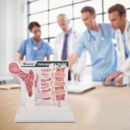 Ultrassist Osteoporosis Model for Teaching, Display, and Communication
