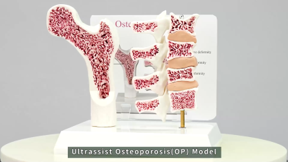 Ultrassist Osteoporosis Model for Teaching Demonstration with Study Card