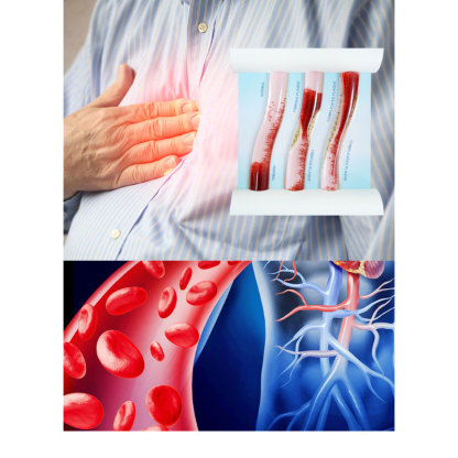 LDL Cholesterol Blood Vessel Model for Medical Education