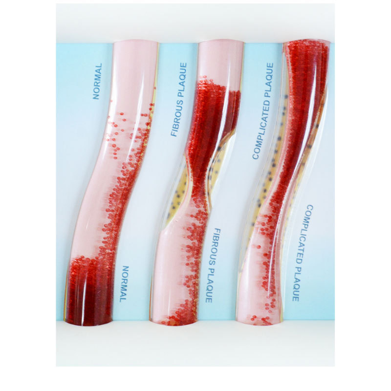 LDL Cholesterol Blood Vessel Model: Healthy Artery vs Fibrous and Combined Plaque Simulation