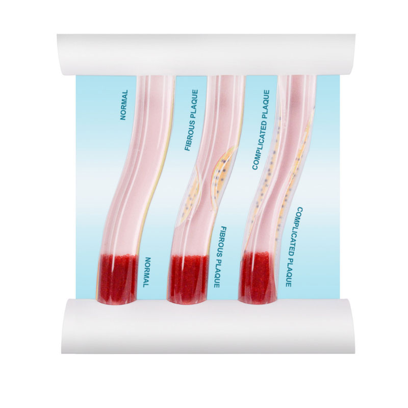 LDL Cholesterol Blood Vessel Model: Normal vs Plaque Stages