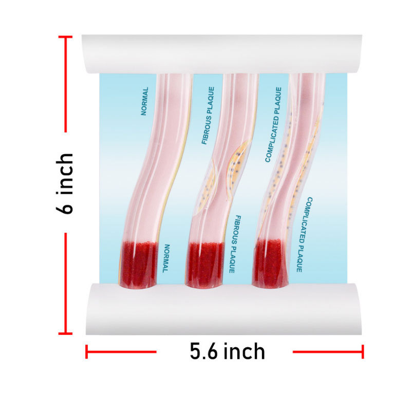 LDL Cholesterol Blood Vessel Model Size