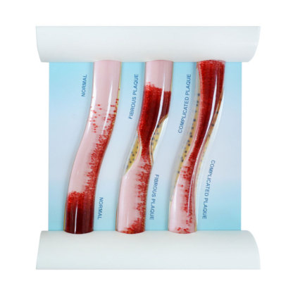 Dynamic LDL Cholesterol Blood Vessel Model