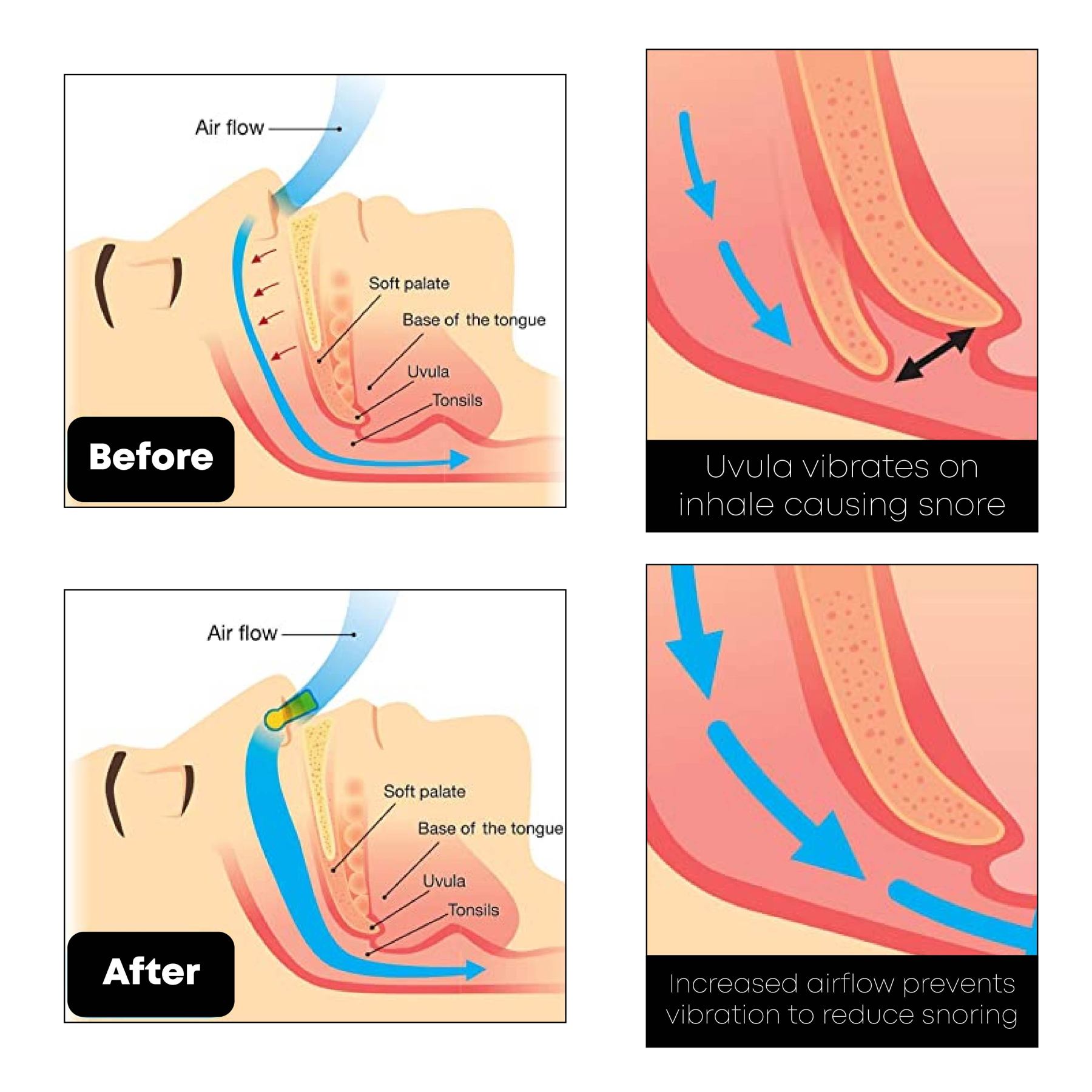 Ricpind Microcurrent AntiSnoring Device-Topselling