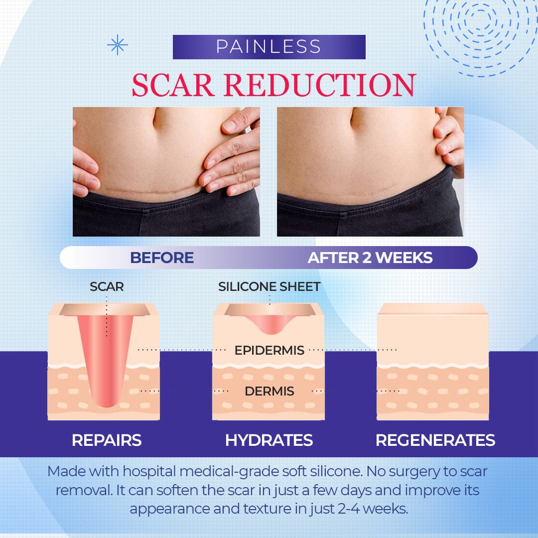 Silicone Scar Sheets